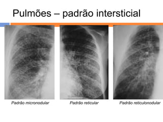 Pulmões – padrão intersticial




Padrão micronodular   Padrão reticular   Padrão reticulonodular


                          .
 