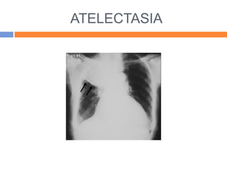 ATELECTASIA
 