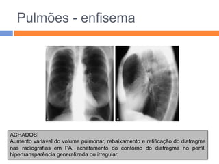 Pulmões - enfisema




ACHADOS:
Aumento variável do volume pulmonar, rebaixamento e retificação do diafragma
nas radiografias em PA, achatamento do contorno do diafragma no perfil,
hipertransparência generalizada ou irregular.
 