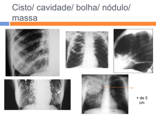 Cisto/ cavidade/ bolha/ nódulo/
massa




                                  + de 3
                                    cm
 