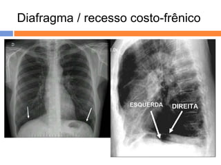 Diafragma / recesso costo-frênico




 Anatomias diafragmática e
      pleural normais
 