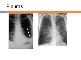 Pleuras




Derrames pleurais, loculado (E) e
 livre (D, com sinal do menisco).
 