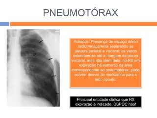PNEUMOTÓRAX

     Achados: Presença de espaço aéreo
        radiotransparente separando as
      pleuras parietal e visceral; os vasos
     estendem-se até a margem da pleura
    visceral, mas não além dela; no RX em
         expiração há aumento da área
    correspondente ao pneumotórax; pode
      ocorrer desvio do mediastino para o
                  lado oposto.




       Principal entidade clínica que RX
      expiração é indicado. DBPOC não!
 
