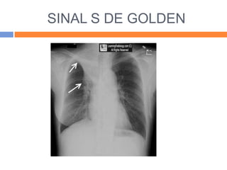 SINAL S DE GOLDEN
 