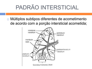 PADRÃO INTERSTICIAL
   Múltiplos subtipos diferentes de acometimento
    de acordo com a porção intersticial acometida;
 