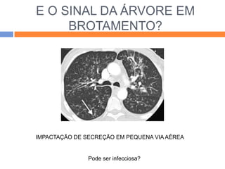 E O SINAL DA ÁRVORE EM
     BROTAMENTO?




IMPACTAÇÃO DE SECREÇÃO EM PEQUENA VIA AÉREA


               Pode ser infecciosa?
 