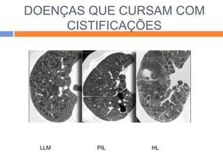 DOENÇAS QUE CURSAM COM
     CISTIFICAÇÕES




 LLM    PIL    HL
 
