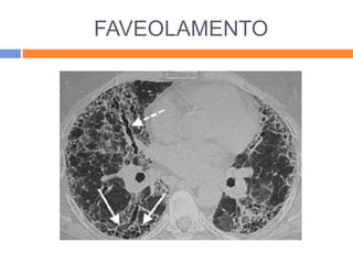 FAVEOLAMENTO
 