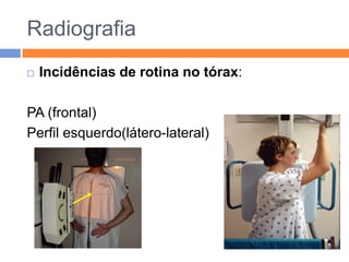 Radiografia
   Incidências de rotina no tórax:

PA (frontal)
Perfil esquerdo(látero-lateral)
 