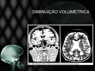 DIMINUIÇÃO VOLUMÉTRICA
 