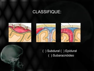 CLASSIFIQUE:




    ( ) Subdural ( ) Epidural
        ( ) Subaracnóideo
 