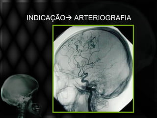 INDICAÇÃO ARTERIOGRAFIA
 