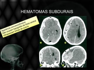 HEMATOMAS SUBDURAIS
 