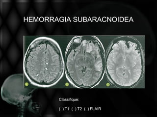 HEMORRAGIA SUBARACNOIDEA




       Classifique:

       ( ) T1 ( ) T2 ( ) FLAIR
 