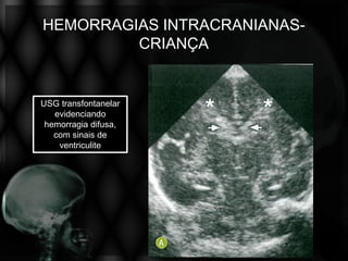 HEMORRAGIAS INTRACRANIANAS-
         CRIANÇA


USG transfontanelar
   evidenciando
 hemorragia difusa,
   com sinais de
    ventriculite
 