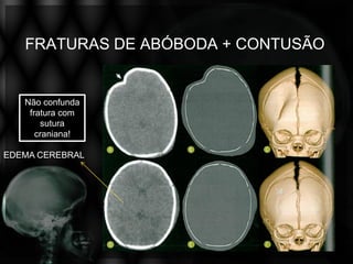 FRATURAS DE ABÓBODA + CONTUSÃO


   Não confunda
    fratura com
       sutura
      craniana!

EDEMA CEREBRAL
 