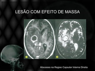 LESÃO COM EFEITO DE MASSA




         Abscesso na Regiao Capsular Interna Direita
 