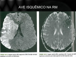 AVE ISQUÊMICO NA RM
 