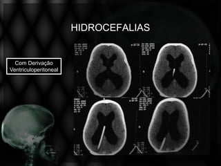 HIDROCEFALIAS


  Com Derivação
Ventriculoperitoneal
 
