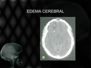 EDEMA CEREBRAL
 