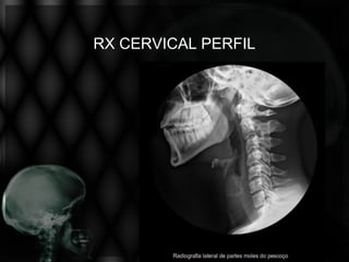 RX CERVICAL PERFIL
 