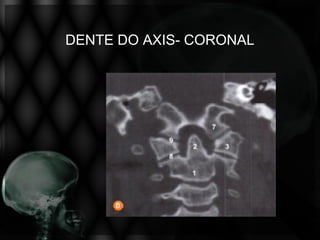 DENTE DO AXIS- CORONAL
 