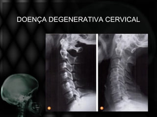 DOENÇA DEGENERATIVA CERVICAL
 