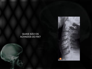 QUAIS SÃO OS
ACHADOS DO RX?
 