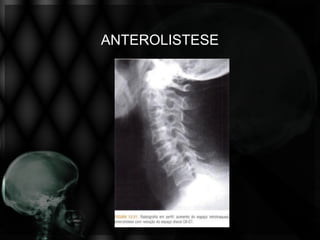 ANTEROLISTESE
 