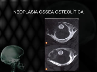 NEOPLASIA ÓSSEA OSTEOLÍTICA
 