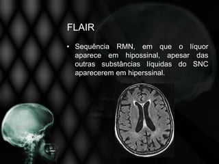 FLAIR
• Sequência RMN, em que o líquor
  aparece em hipossinal, apesar das
  outras substâncias líquidas do SNC
  aparecerem em hiperssinal.
 