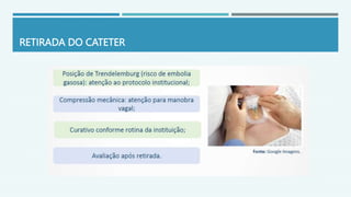 RETIRADA DO CATETER
 