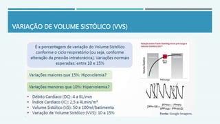 VARIAÇÃO DE VOLUME SISTÓLICO (VVS)
 