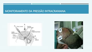 MONITORAMENTO DA PRESSÃO INTRACRANIANA
 