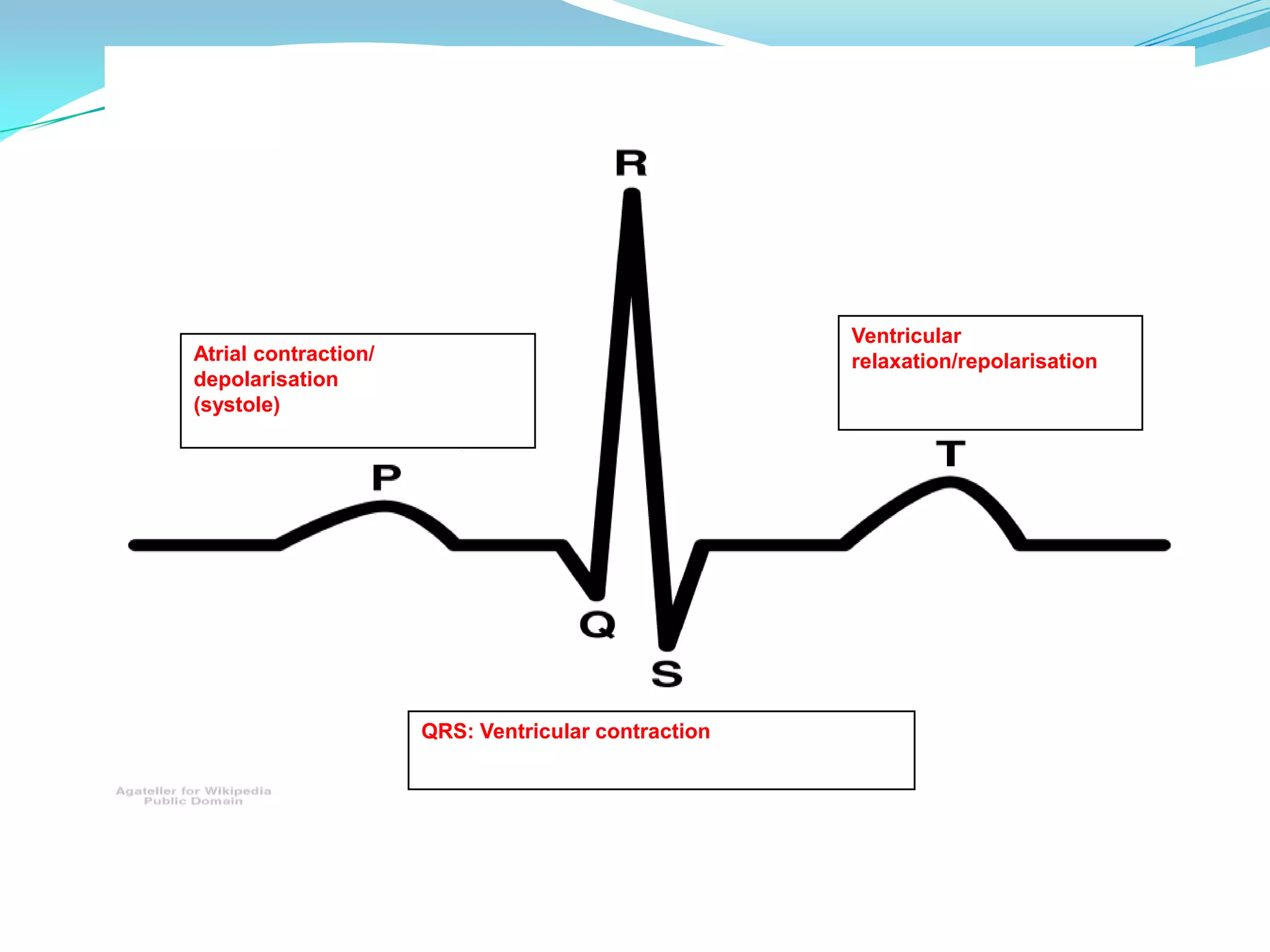 Normal Sinus Rhythm (NSR)According to Wicker & O neil (2006)-The sinus node produces an electrical impulse launching a normal heart rhythmSignal radiates through right and left atrial muscles producing electrical changes         stimulating atria causing atrial contraction (P wave)Impulse continues through AV node conducting electricity at slower pace (PR interval) Pause between atrial and ventricular systole-blood empties from atria into ventriclesVentricular contraction (QRS) –blood propels towards aorta and pulmonary arteryT wave- ventricles relaxing