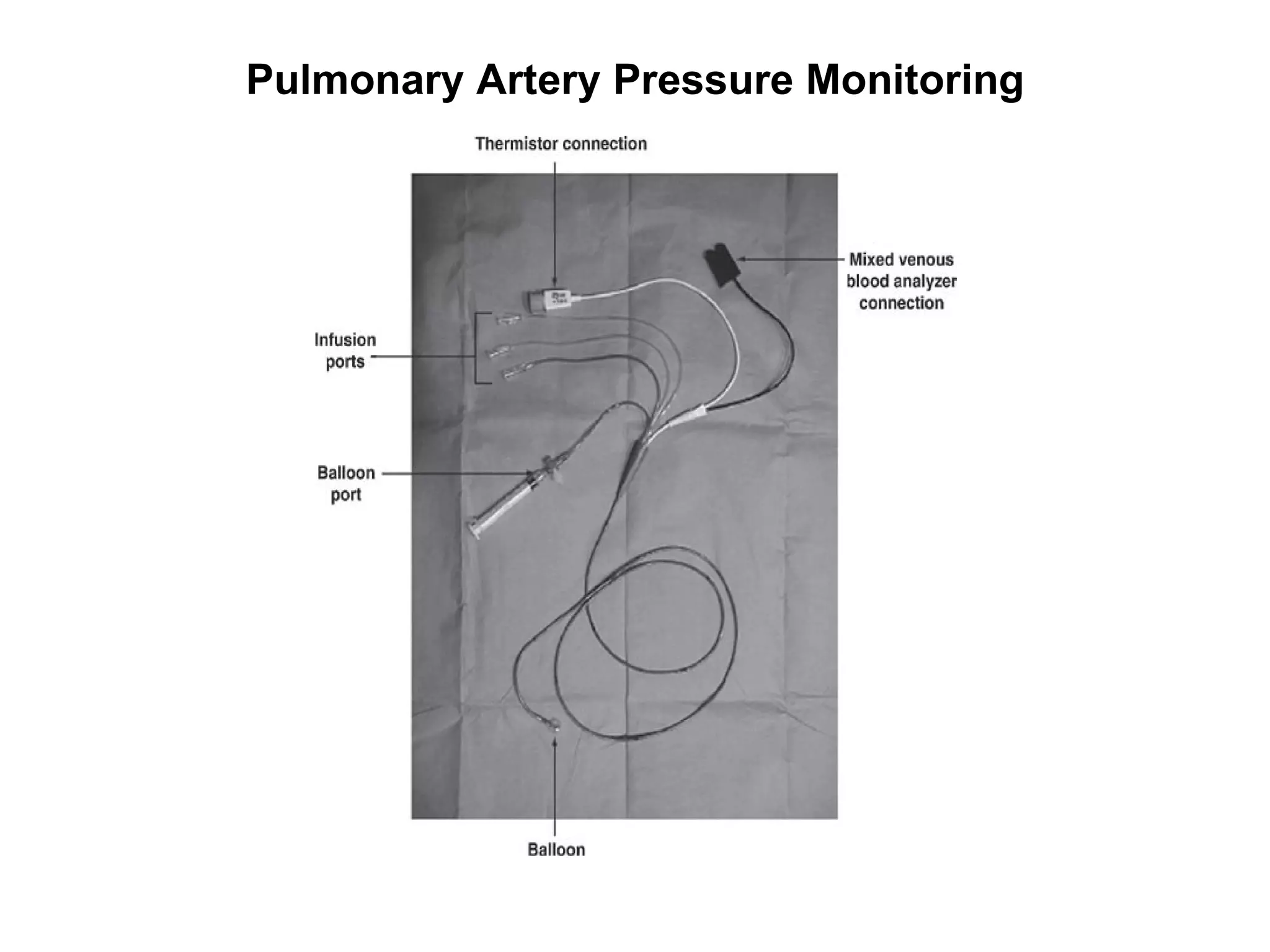 Pulmonary Artery Pressure Monitoring
 