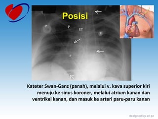 Posisi Kateter Swan-Ganz (panah), melalui v. kava superior kiri menuju ke sinus koroner, melalui atrium kanan dan ventrikel kanan, dan masuk ke arteri paru-paru kanan 