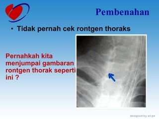 Pembenahan Tidak pernah cek rontgen thoraks Pernahkah kita menjumpai gambaran  rontgen thorak seperti ini ? 