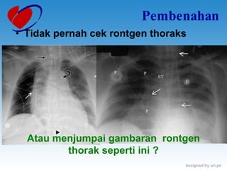 Pembenahan Tidak pernah cek rontgen thoraks Atau menjumpai gambaran  rontgen thorak seperti ini ? 