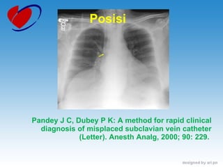 Posisi Pandey J C, Dubey P K: A method for rapid clinical diagnosis of misplaced subclavian vein catheter (Letter). Anesth Analg, 2000; 90: 229.  