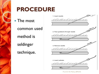 PROCEDURE
 The most
common used
method is
seldinger
technique.
Prof.Dr. RS Mehta, BPKIHS
 