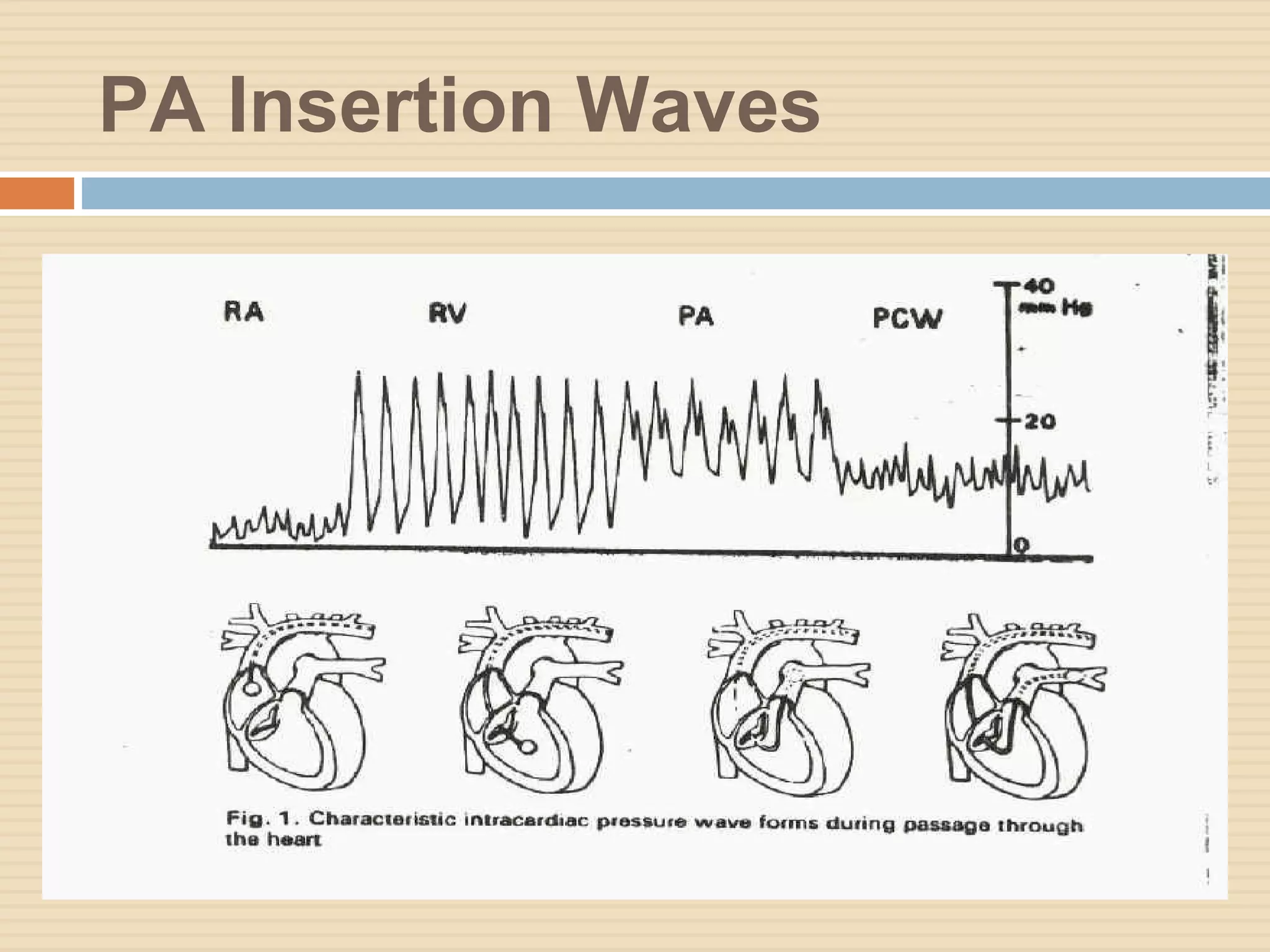 PA Insertion Waves
 