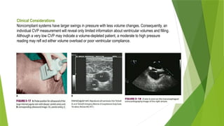 Clinical Considerations
Noncompliant systems have larger swings in pressure with less volume changes. Consequently, an
individual CVP measurement will reveal only limited information about ventricular volumes and filling.
Although a very low CVP may indicate a volume-depleted patient, a moderate to high pressure
reading may refl ect either volume overload or poor ventricular compliance.
 