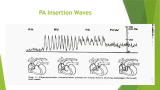 PA Insertion Waves
 