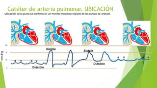 0
10
2 0
30
a v a v
a v a v
Sístole
Sístole
Diástole
Diástole
mm
Hg
Catéter de arteria pulmonar. UBICACIÓN
Ubicación de la punta se confirma en un monitor mediante registro de las curvas de presión.
 