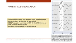 POTENCIALES EVOCADOS
El SSEP ha sido usado para detectar zonas isquémicas en el
tejido cortical por la reducción de la amplitud.
El SSEP se vuelve anormal a un FSC de 20ml/100g/min y se
pierde a los 15-18 ml/100g/min.
Usado en cirugías de ACM y carótida interna
Cottrell JE, Patel P. Cottrell and Patel’s Neuroanesthesia. 2017; 6th edition. Elsevier
 