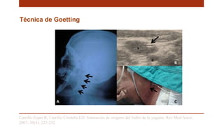 Técnica de Goetting
Carrillo-Esper R, Carrillo-Córdoba LD. Saturación de oxigeno del bulbo de la yugular. Rev Med Anest.
2007; 30(4): 225-232
 