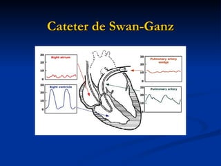 Cateter de Swan-Ganz 