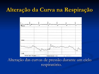 Alteração da Curva na Respiração Alteração das curvas de pressão durante um ciclo respiratório. 