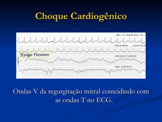Choque Cardiogênico Ondas V da regurgitação mitral coincidindo com as ondas T no ECG. 